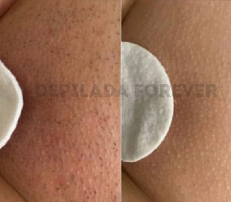 Laura M. – Piernas sensibles